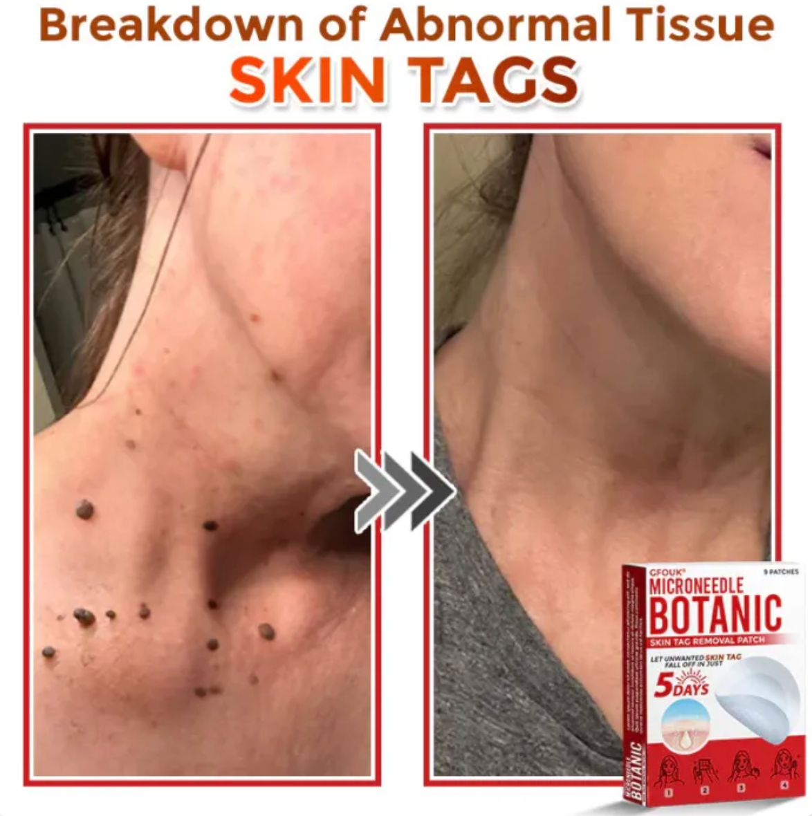 GRATIAO Removal Patch (2+1 Free)
