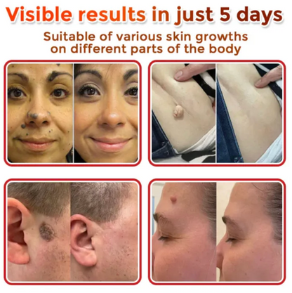 GRATIAO Removal Patch (2+1 Free)